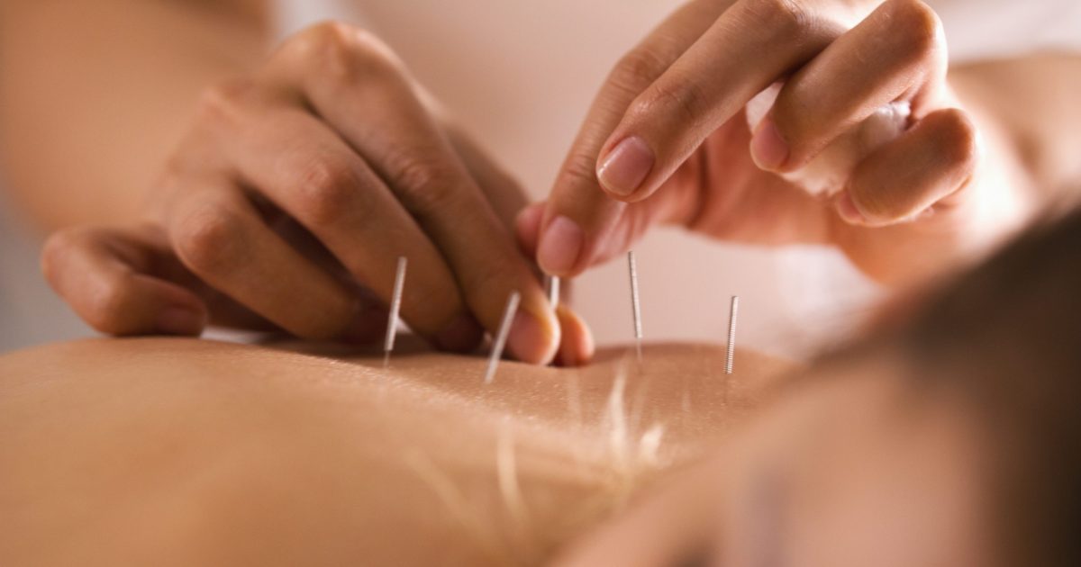 Co to jest akupunktura, elektroakupunktura i akupresura?!